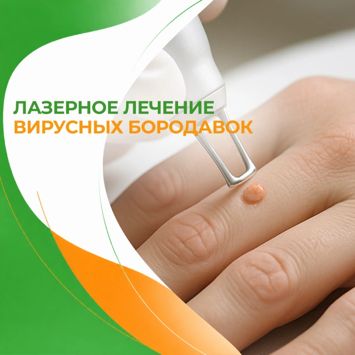Лазерное лечение вирусных бородавок в медицинской клинике ПерсонаМед Ухта