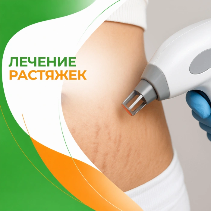 Лечение растяжек в медицинской клинике ПерсонаМед Ухта