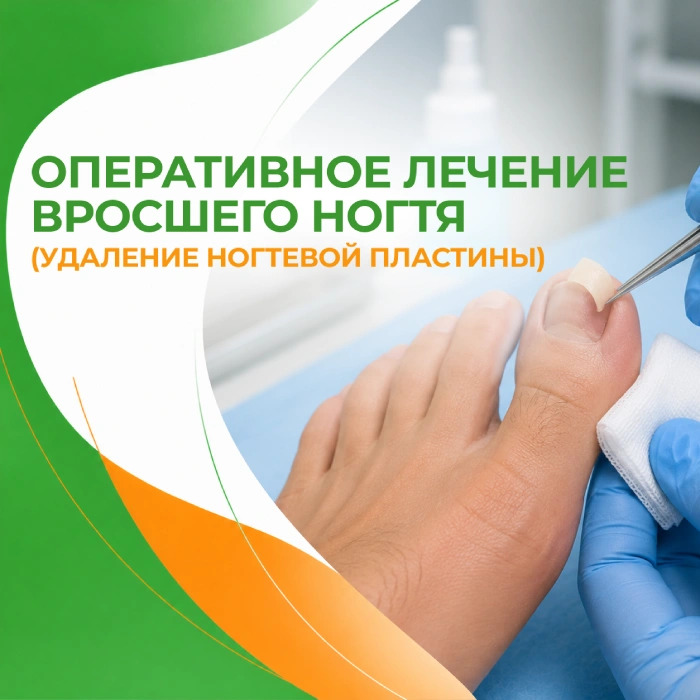 Удаление ногтевой пластины в медицинской клинике ПерсонаМед Ухта
