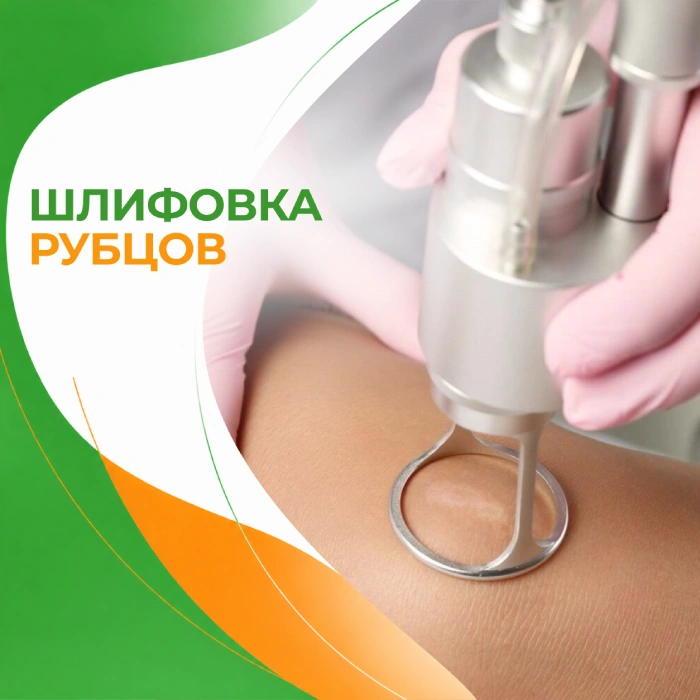 Шлифовка рубцов в медицинской клинике ПерсонаМед Ухта